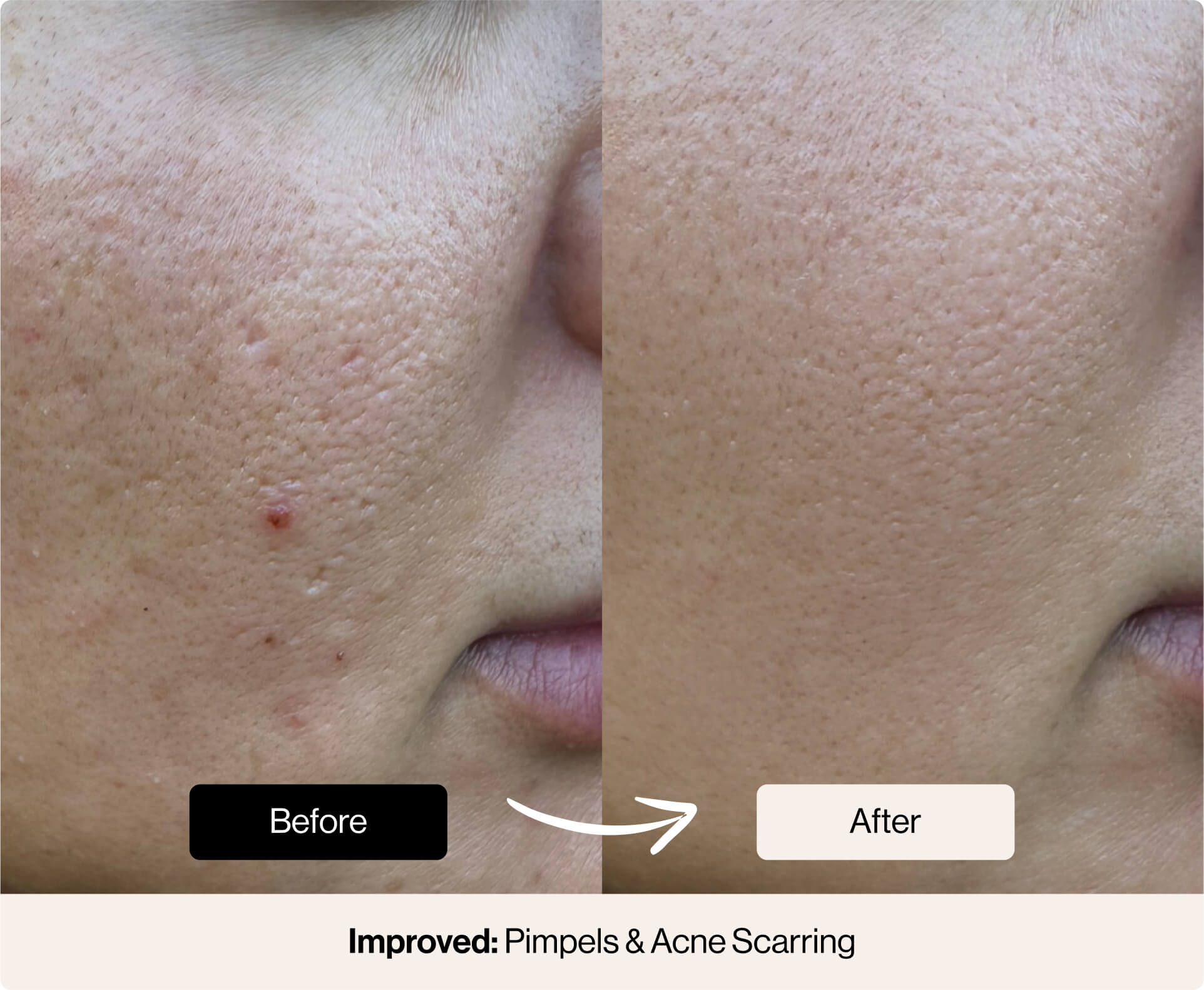 Bio-Microneedling Facial Kit - Sassy Saints